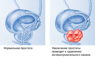 Illustration showing an inflamed prostate gland, a condition known as prostatitis. Here, the male urogenital tract is seen, with bladder at centre. Ureters (white, at top) transport urine from kid- neys to the bladder. The inflamed prostate gland beneath the bladder exudes a yellow discharge into the urethra (the canal transporting urine to the exterior). Prostatitis is a bacterial infection that may affect reproductive capacity and can be sexually transmitted. It can make urination pain- ful. Other seminal fluid producing organs may also become infected: as has a seminal vesicle (centre right, looping around the bladder). Despite anti- biotic drug treatment this condition may recur.